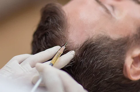 PRP терапия (плазмолифтинг) за коса при мъж.