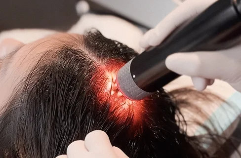 Лазерна терапия с червена светлина за стимулация на скалпа.